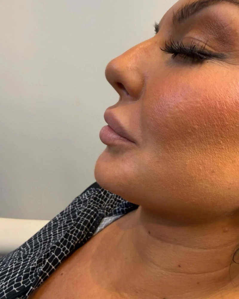 Before lip augmentation treatment