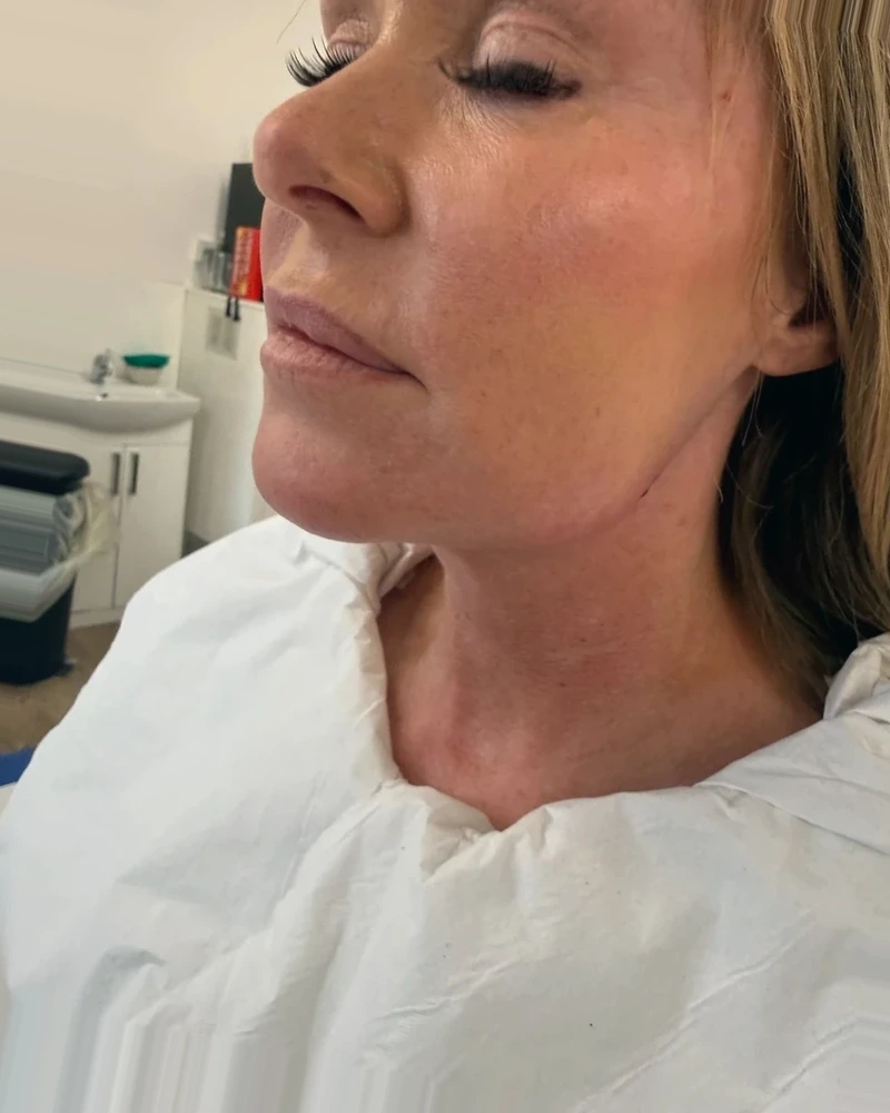 After Ultimate Facelift treatment, clinic case 2
